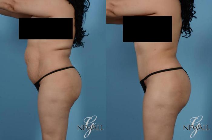 Before & After Tummy Tuck Case 17363 View 3 View in Houston, TX