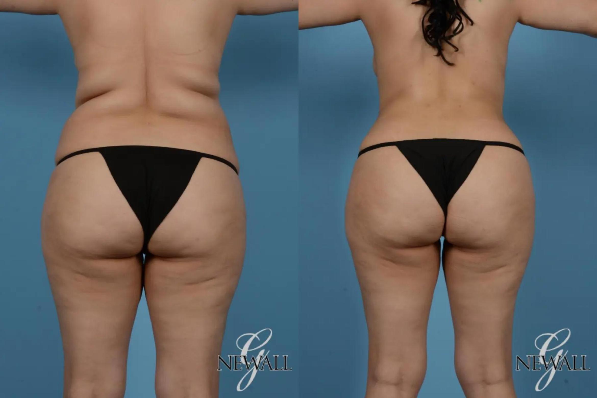 Before & After Tummy Tuck Case 17363 View 4 View in Houston, TX