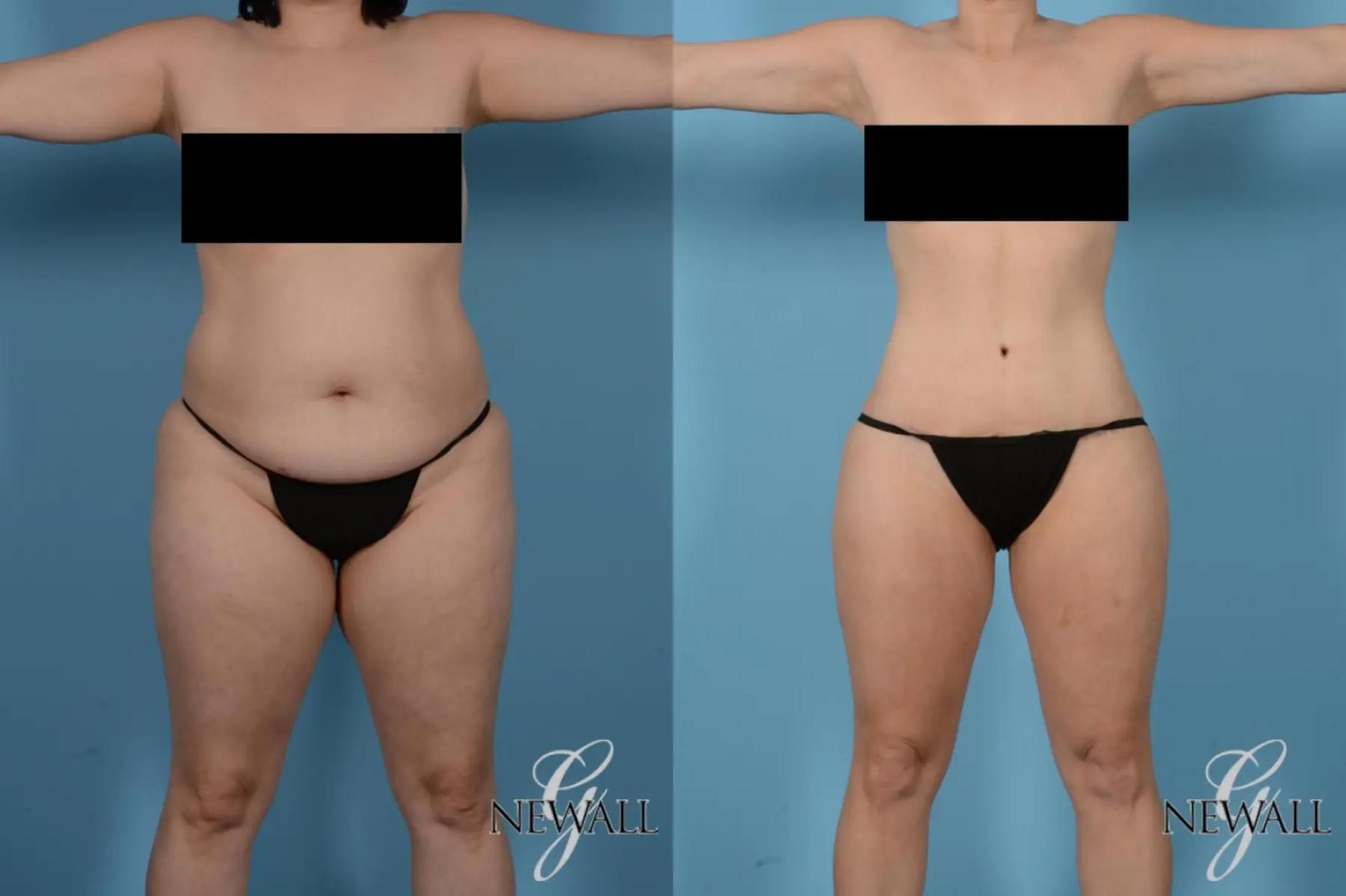 Before & After Tummy Tuck Case 17441 View 1 View in Houston, TX