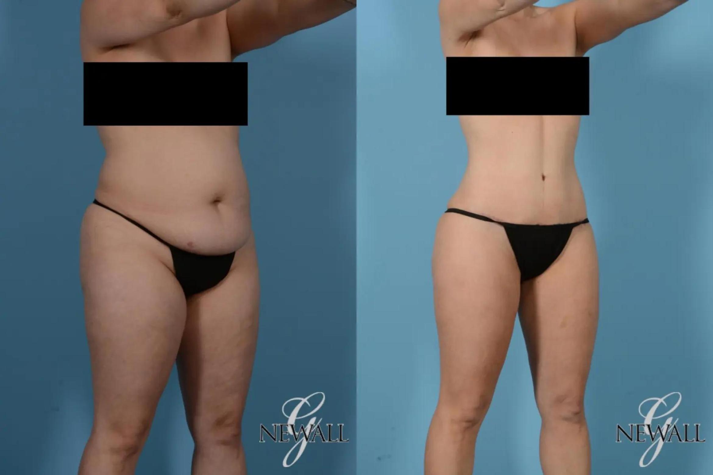 Before & After Tummy Tuck Case 17441 View 2 View in Houston, TX