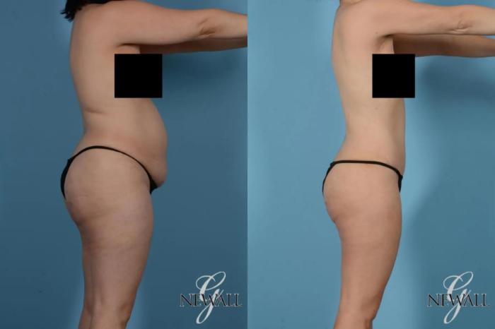 Before & After Tummy Tuck Case 17441 View 3 View in Houston, TX