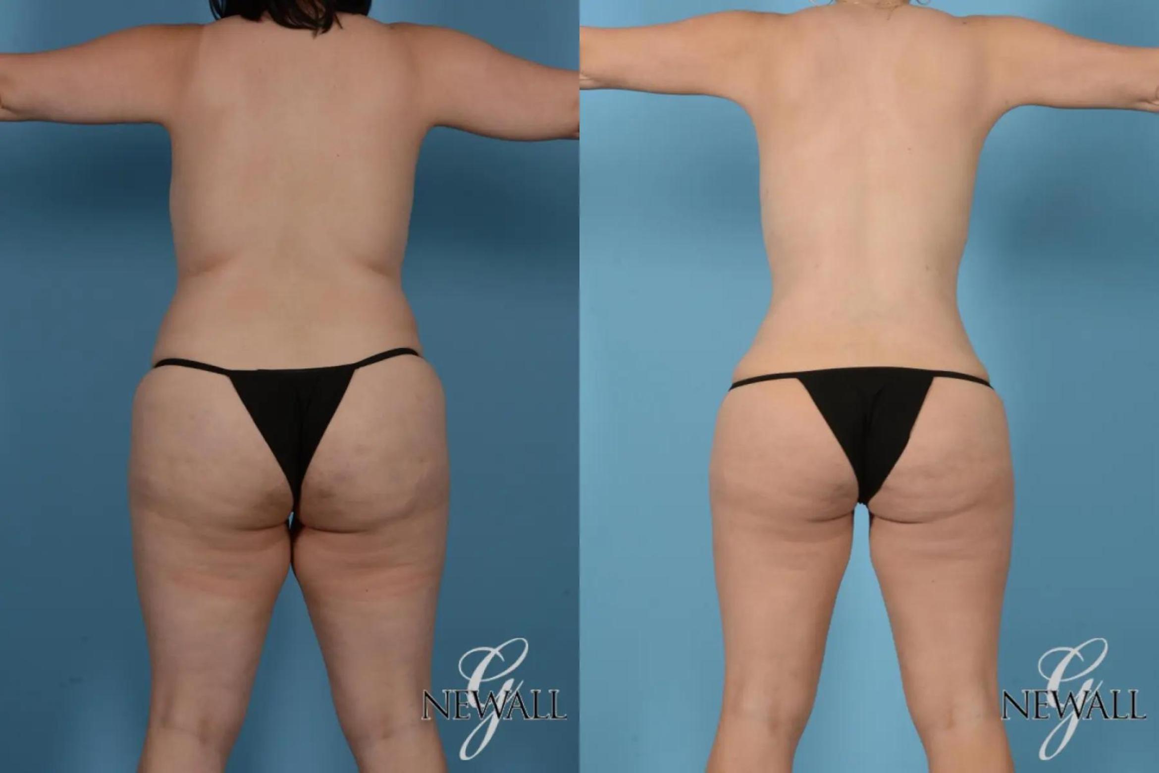 Before & After Tummy Tuck Case 17441 View 4 View in Houston, TX
