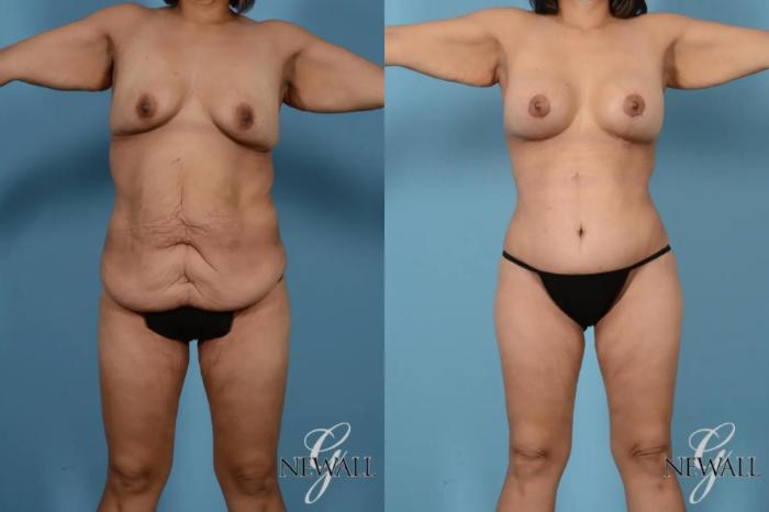 Before & After Tummy Tuck Case 17443 View 1 View in Houston, TX
