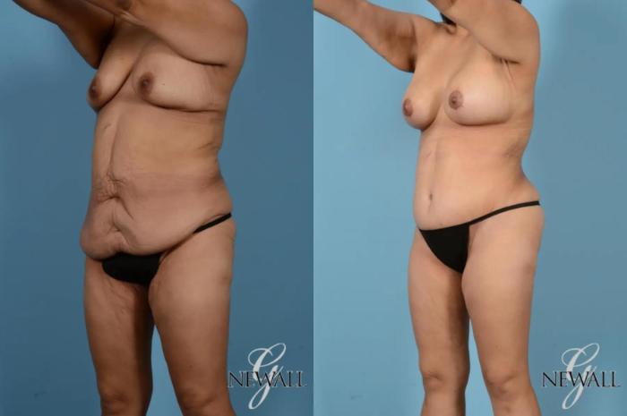 Before & After Tummy Tuck Case 17443 View 2 View in Houston, TX