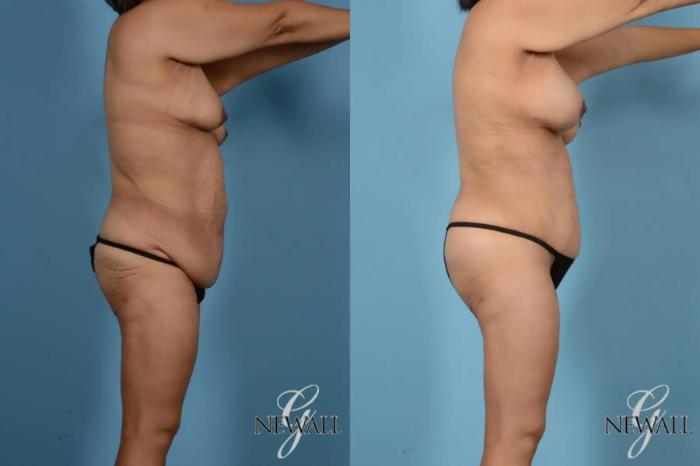 Before & After Tummy Tuck Case 17443 View 3 View in Houston, TX