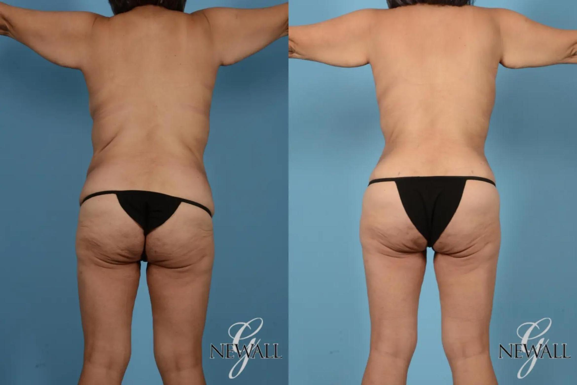 Before & After Tummy Tuck Case 17443 View 4 View in Houston, TX