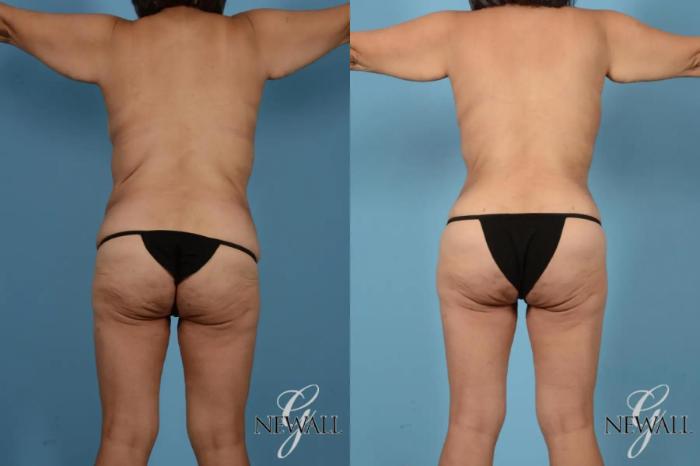Before & After Tummy Tuck Case 17443 View 4 View in Houston, TX