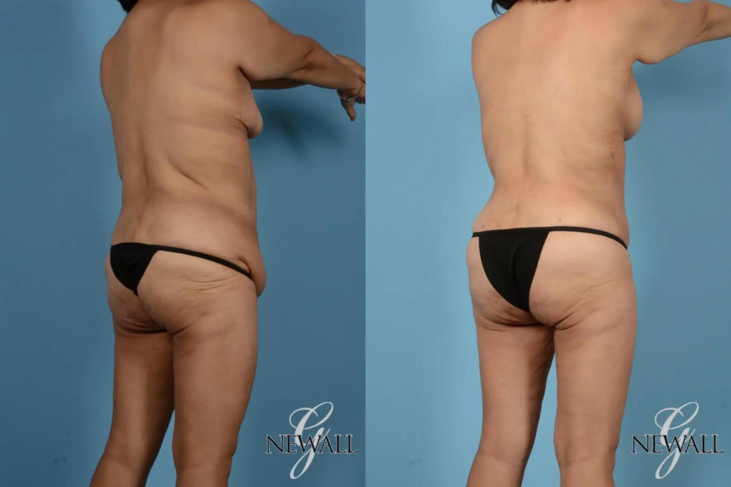 Before & After Tummy Tuck Case 17443 View 5 View in Houston, TX