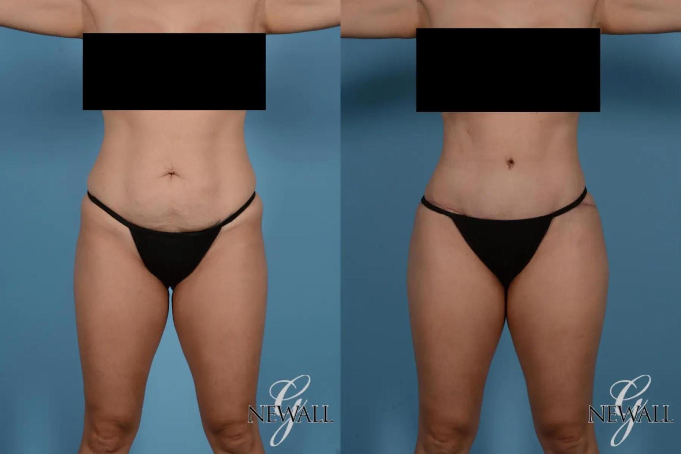 Before & After Tummy Tuck Case 17518 View 1 View in Houston, TX