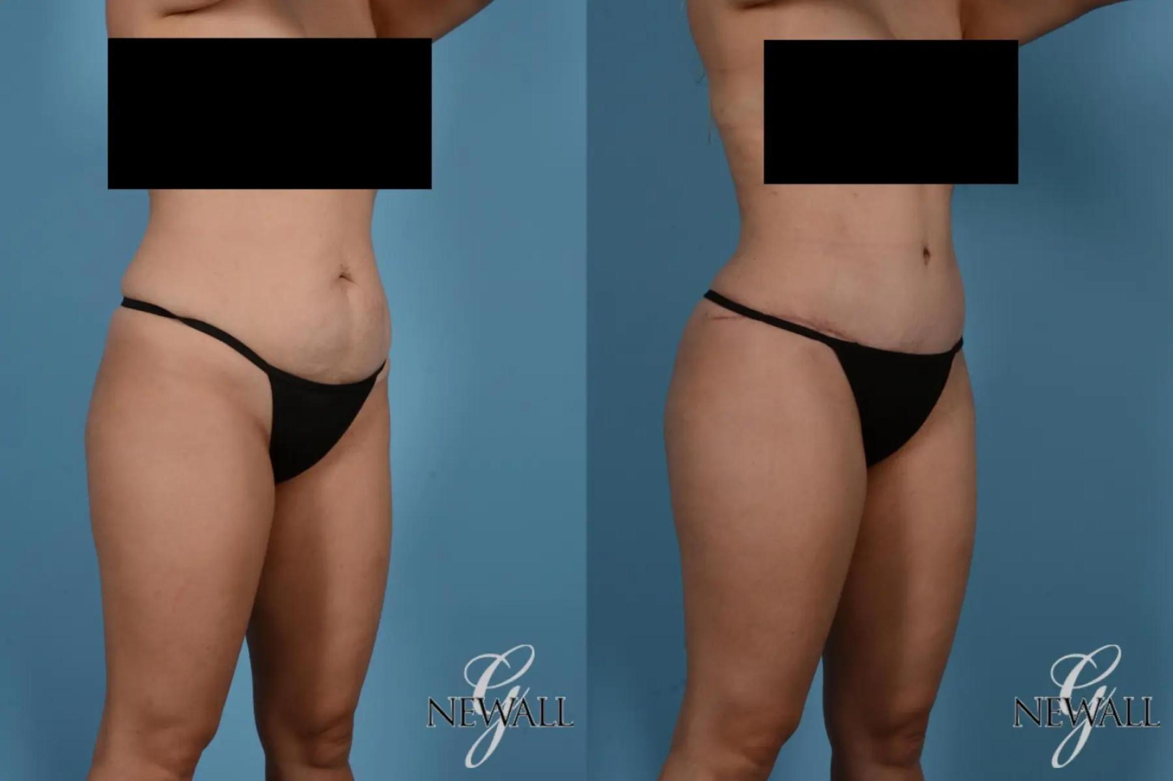Before & After Tummy Tuck Case 17518 View 2 View in Houston, TX