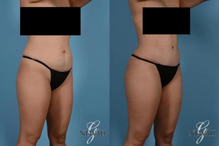 Before & After Tummy Tuck Case 17518 View 2 View in Houston, TX