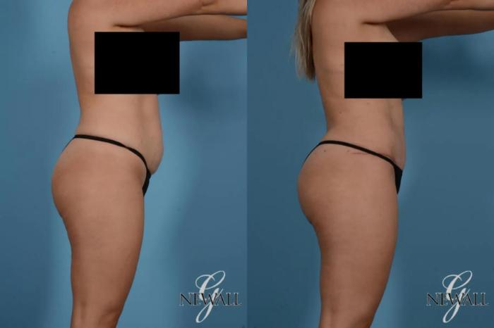 Before & After Tummy Tuck Case 17518 View 3 View in Houston, TX