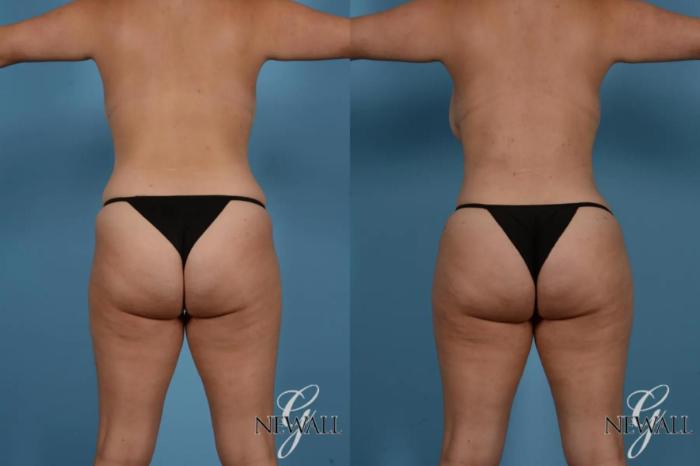 Before & After Tummy Tuck Case 17518 View 4 View in Houston, TX