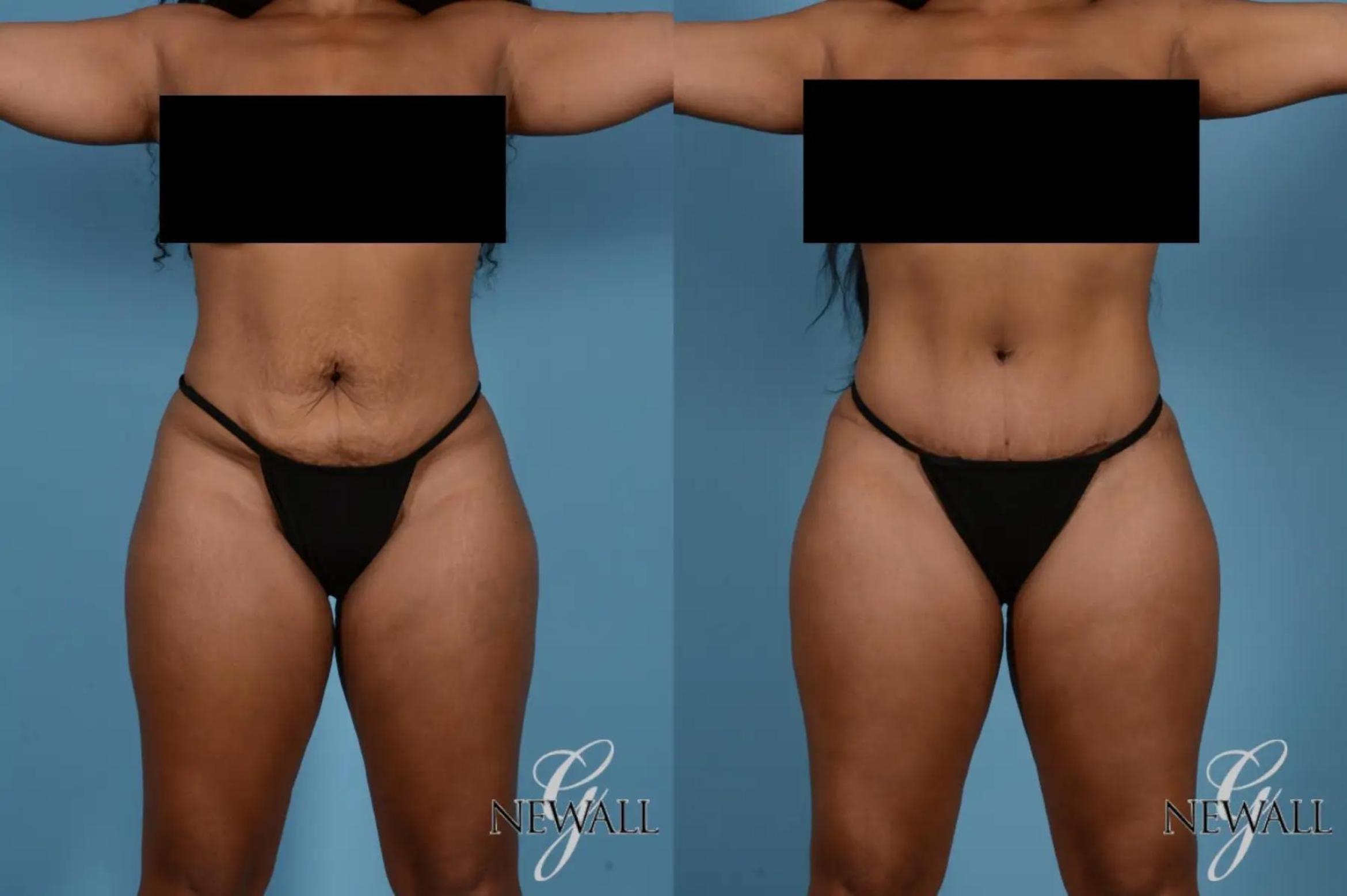 Before & After Tummy Tuck Case 17531 View 1 View in Houston, TX