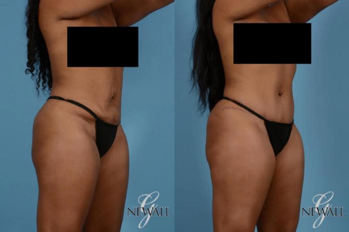 Before & After Tummy Tuck Case 17531 View 2 View in Houston, TX