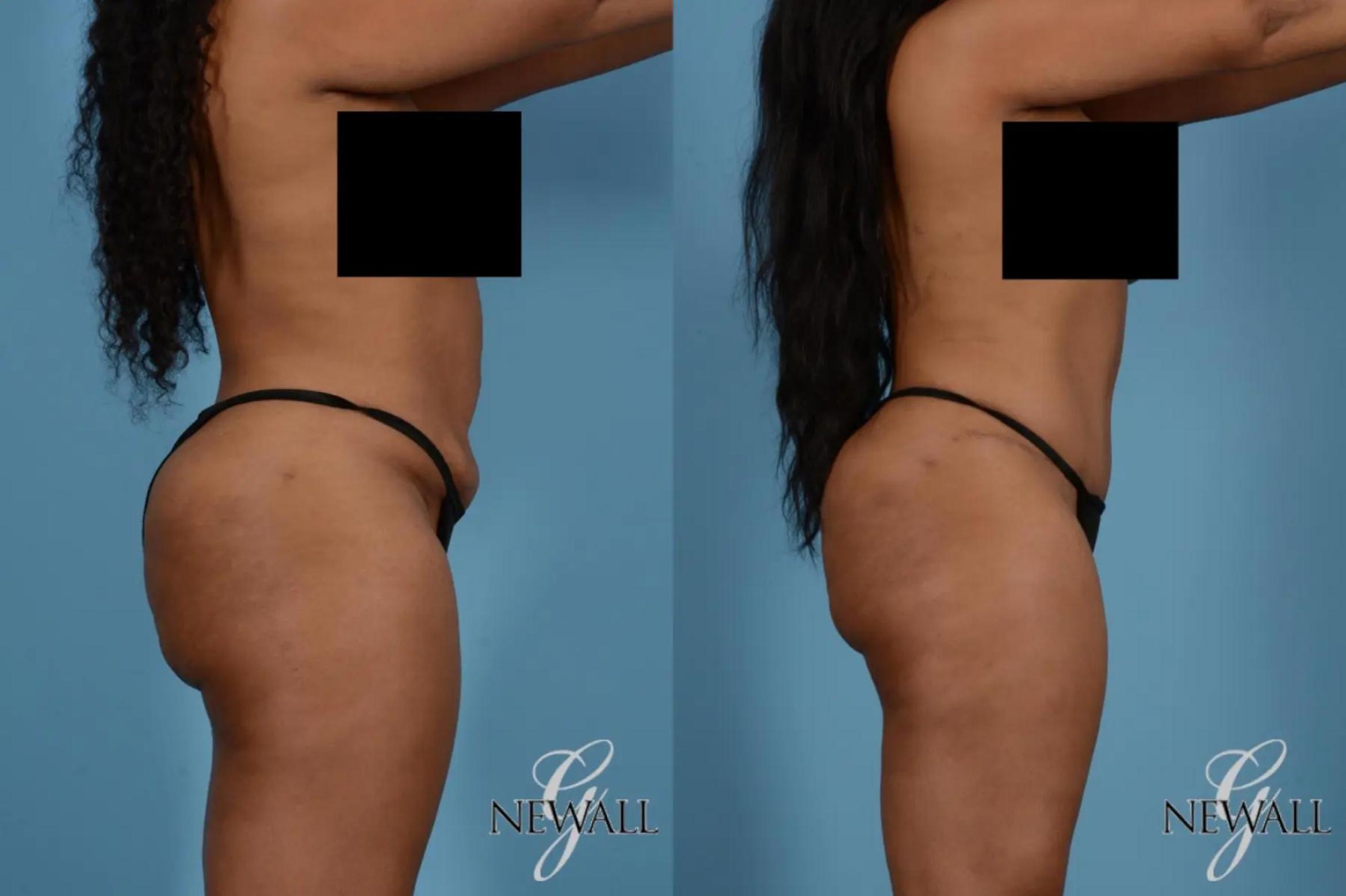Before & After Tummy Tuck Case 17531 View 3 View in Houston, TX