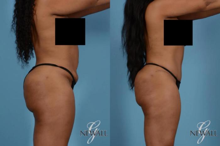 Before & After Tummy Tuck Case 17531 View 3 View in Houston, TX