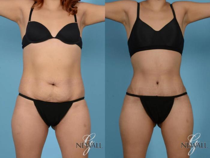 Before & After Tummy Tuck Case 17755 View 1 View in Houston, TX