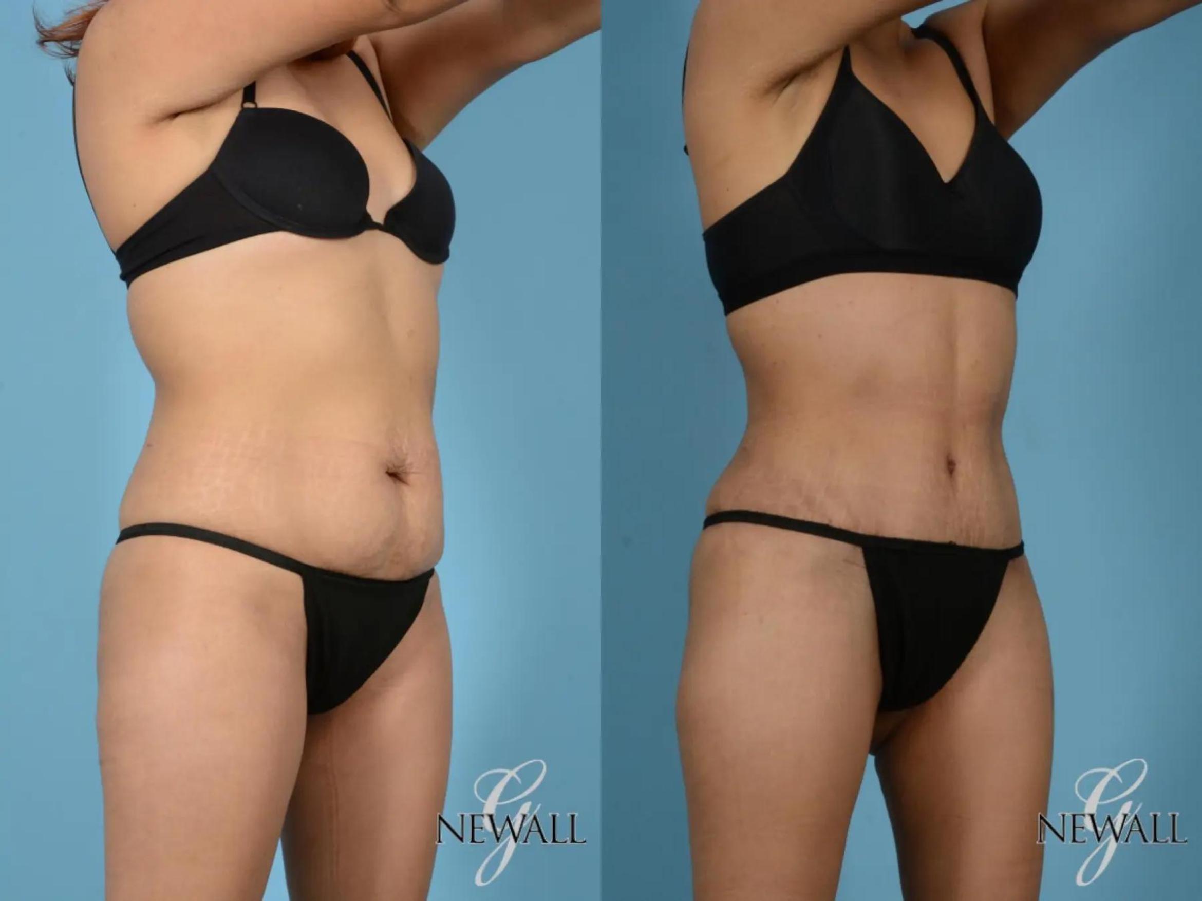 Before & After Tummy Tuck Case 17755 View 2 View in Houston, TX
