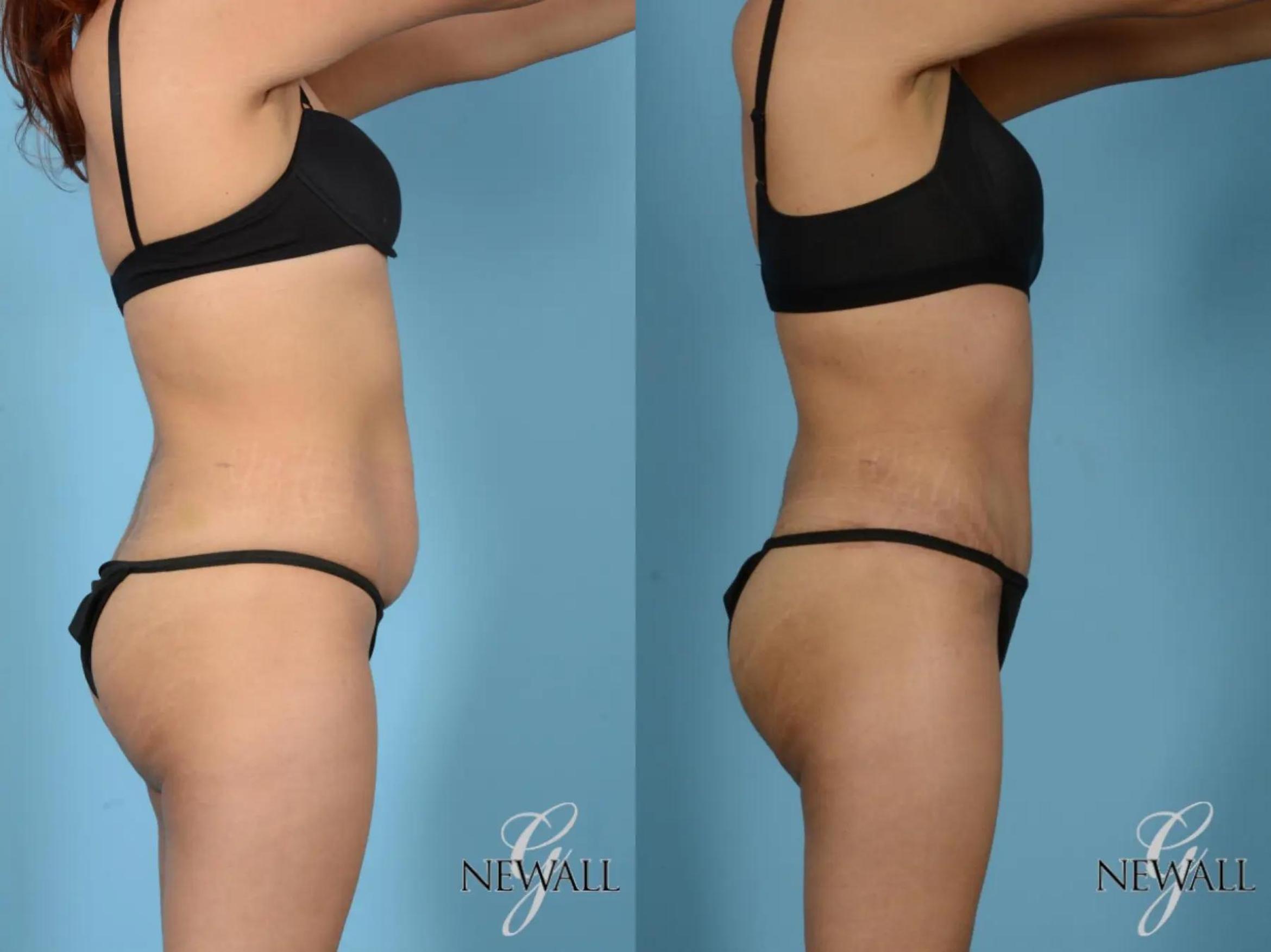 Before & After Tummy Tuck Case 17755 View 3 View in Houston, TX