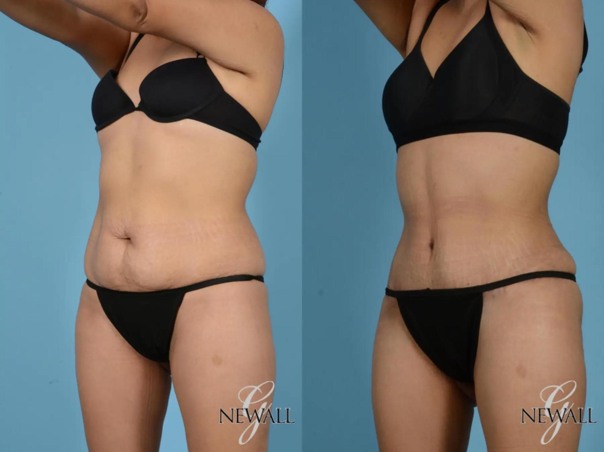 Before & After Tummy Tuck Case 17755 View 4 View in Houston, TX