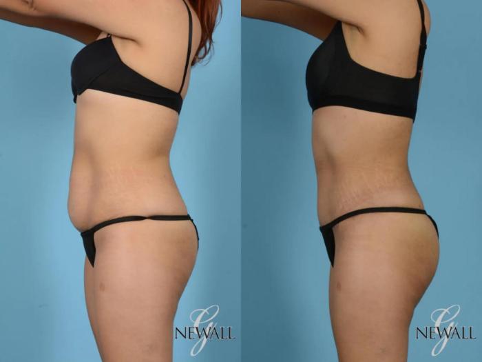 Before & After Tummy Tuck Case 17755 View 5 View in Houston, TX
