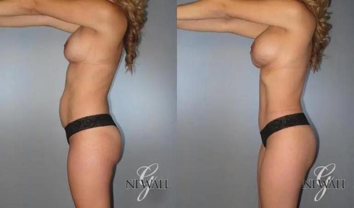 Before & After Tummy Tuck Case 17820 View 3 View in Houston, TX