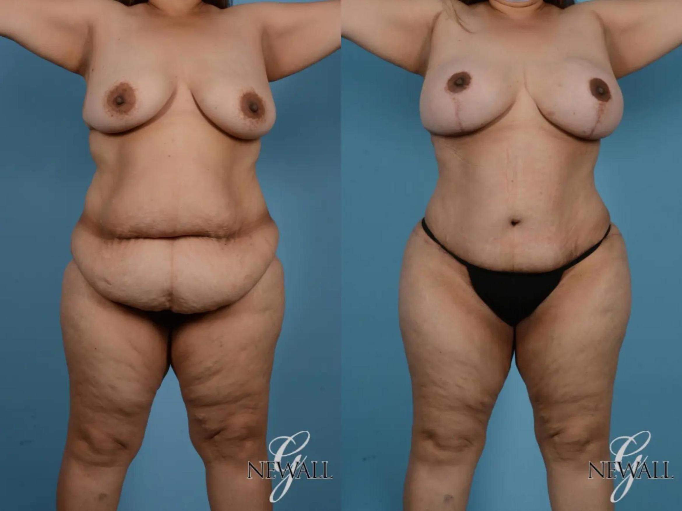 Before & After Tummy Tuck Case 17848 View 1 View in Houston, TX