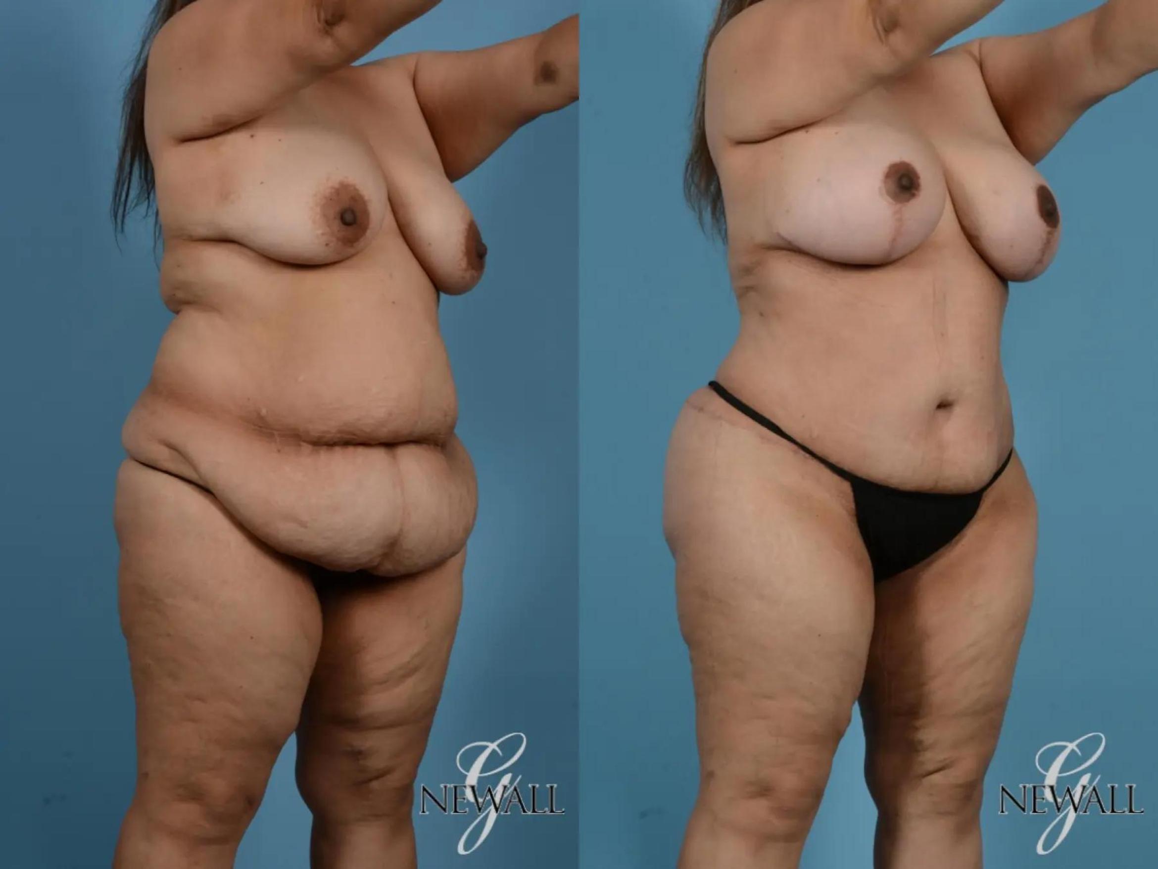 Before & After Tummy Tuck Case 17848 View 2 View in Houston, TX