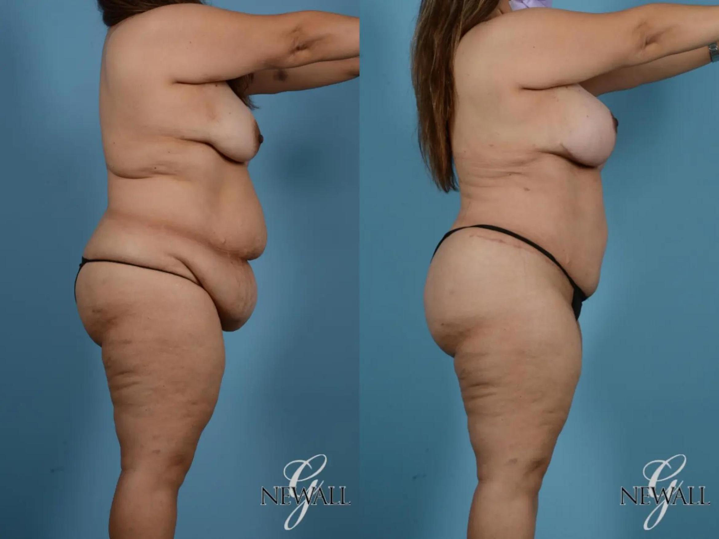 Before & After Tummy Tuck Case 17848 View 3 View in Houston, TX