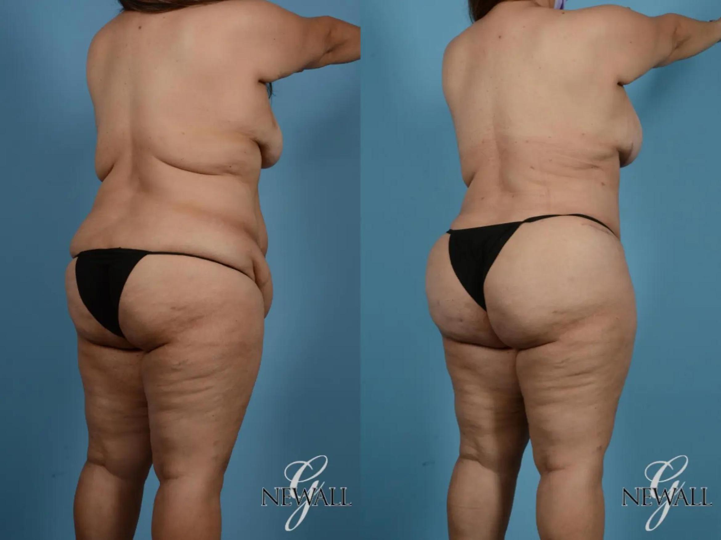Before & After Tummy Tuck Case 17848 View 4 View in Houston, TX