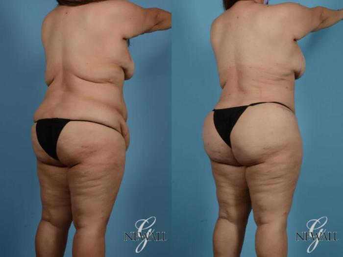 Before & After Tummy Tuck Case 17848 View 4 View in Houston, TX