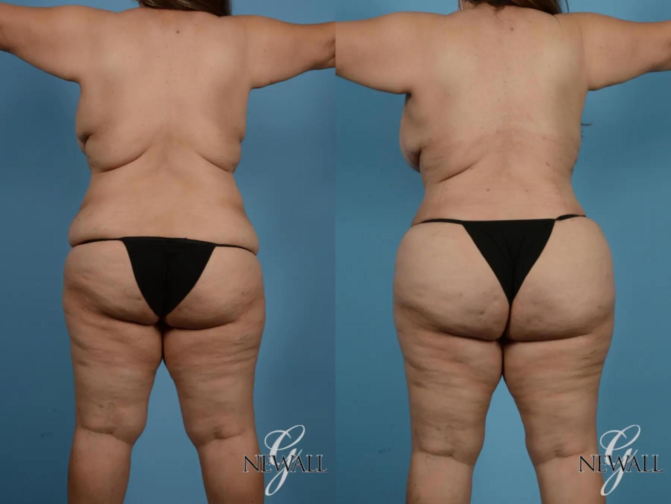 Before & After Tummy Tuck Case 17848 View 5 View in Houston, TX