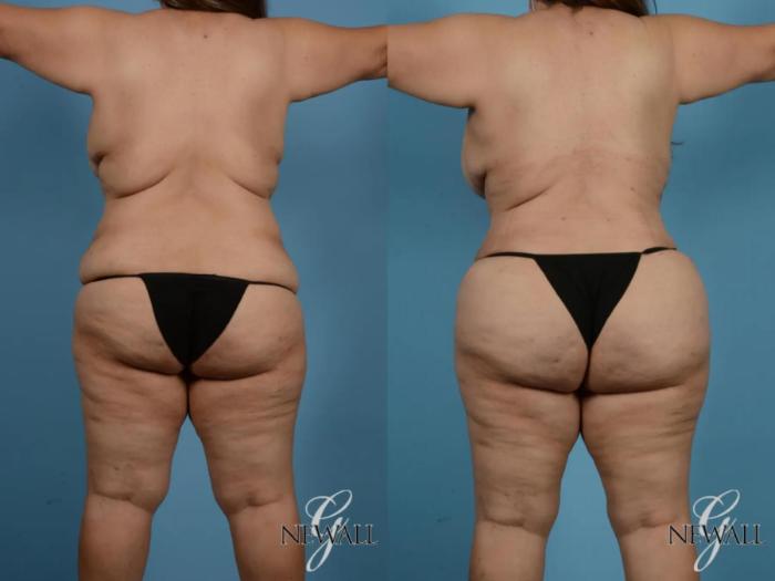 Before & After Tummy Tuck Case 17848 View 5 View in Houston, TX