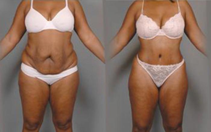 Before & After Tummy Tuck Case 18 View 1 View in Houston, TX
