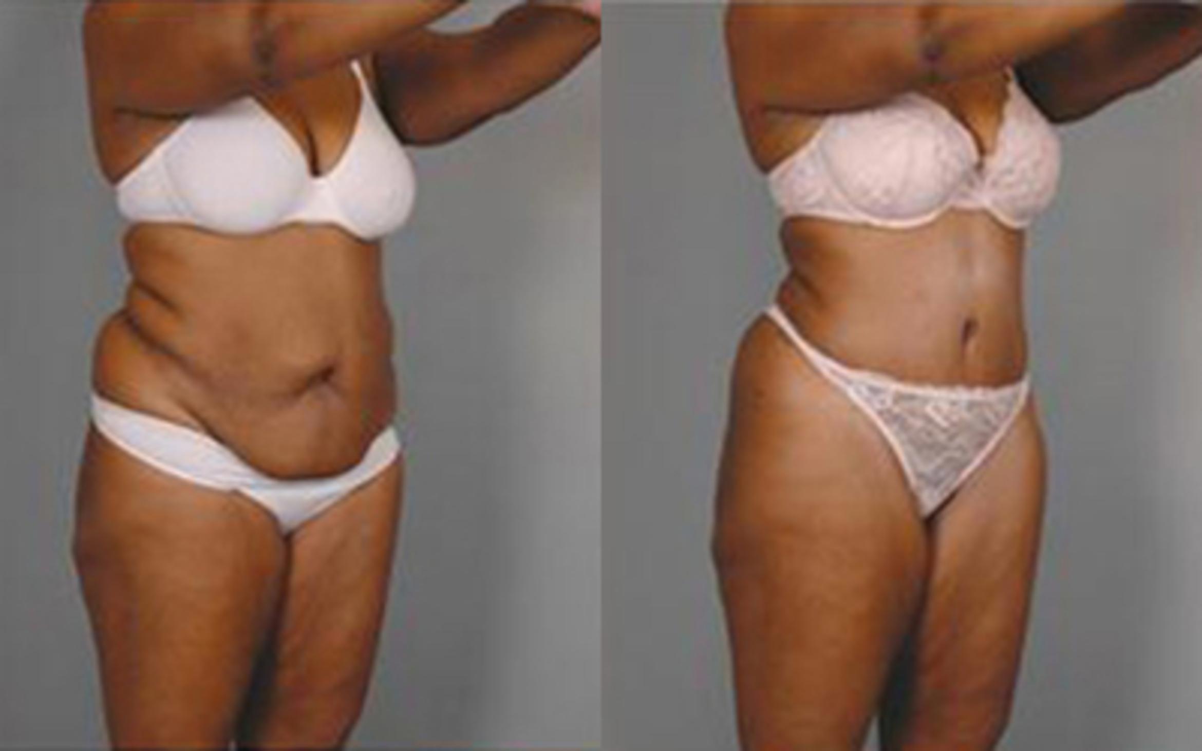 Before & After Tummy Tuck Case 18 View 2 View in Houston, TX