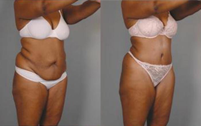 Before & After Tummy Tuck Case 18 View 2 View in Houston, TX
