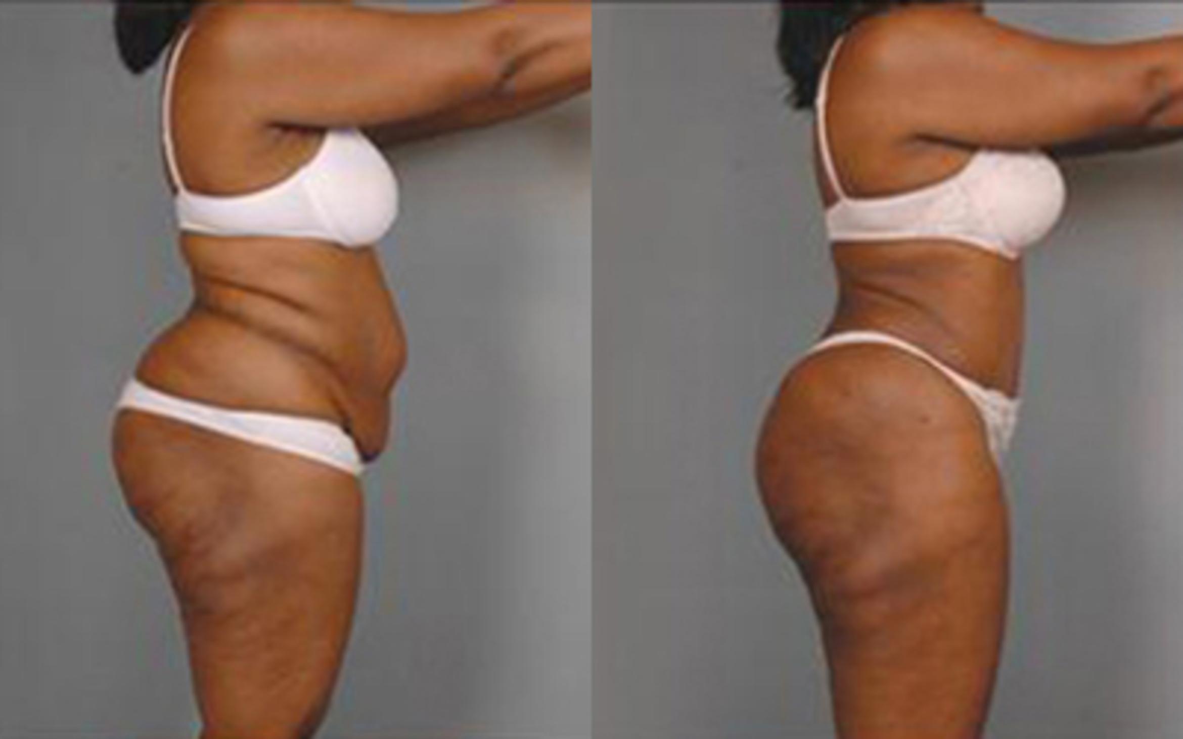 Before & After Tummy Tuck Case 18 View 3 View in Houston, TX