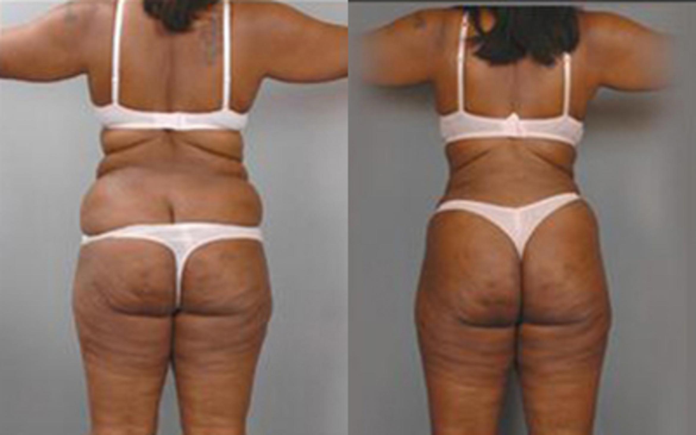Before & After Tummy Tuck Case 18 View 4 View in Houston, TX