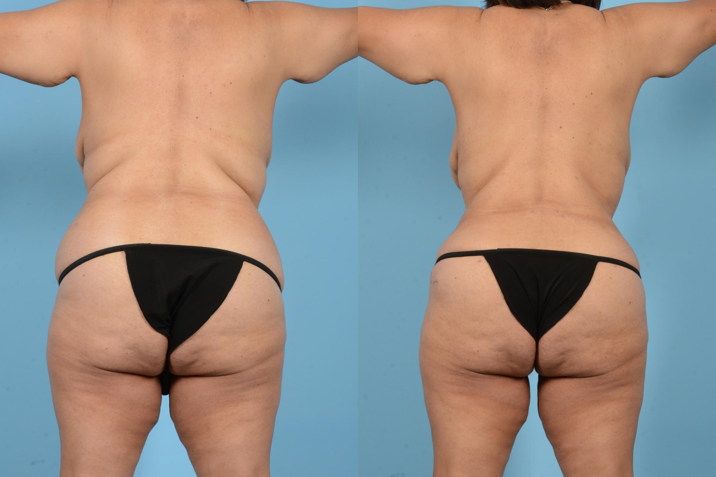 Before & After Liposuction Case 18126 Back View in Houston, TX