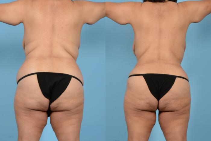 Before & After Liposuction Case 18126 Back View in Houston, TX