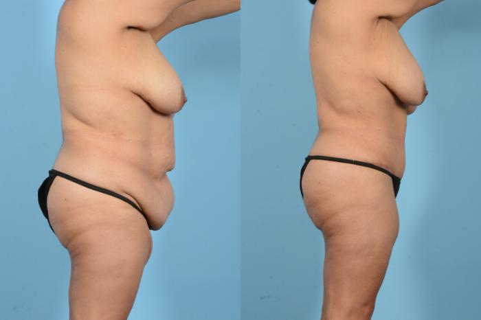Before & After Liposuction Case 18126 Right Side View in Houston, TX