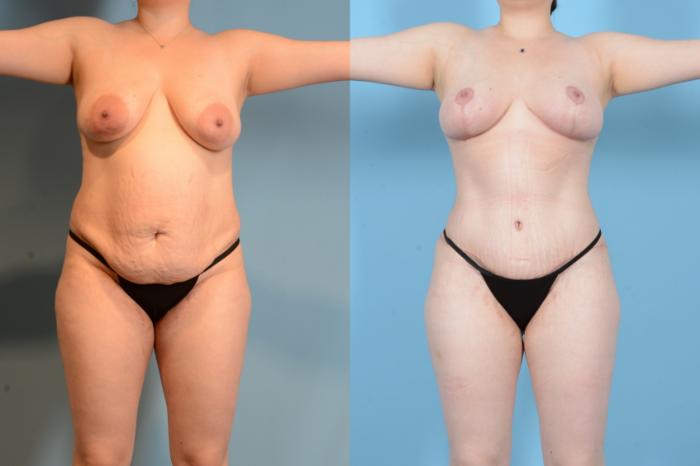 Before & After Liposuction Case 18128 Front View in Houston, TX