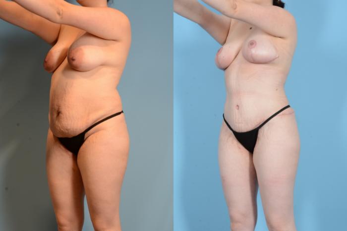 Before & After Liposuction Case 18128 Left Oblique View in Houston, TX