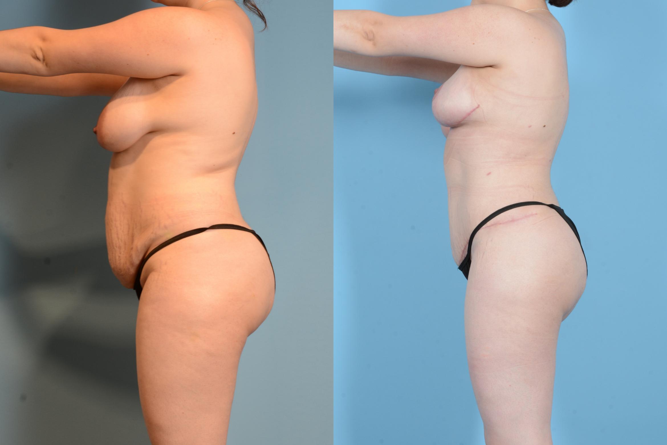 Before & After Liposuction Case 18128 Left Side View in Houston, TX
