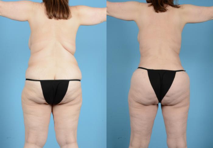 Before & After Tummy Tuck Case 18132 Back View in Houston, TX