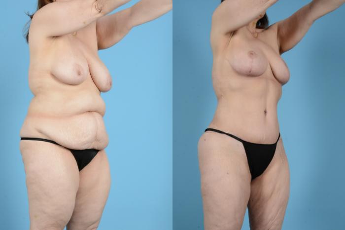 Before & After Brazilian Butt Lift Case 18132 Right Oblique View in Houston, TX