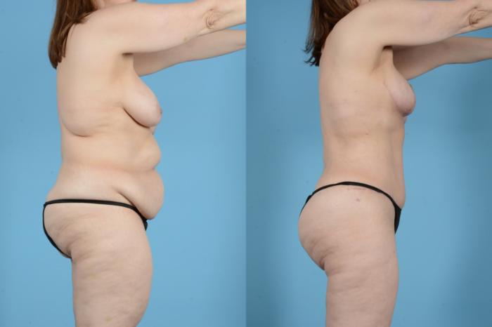 Before & After Brazilian Butt Lift Case 18132 Right Side View in Houston, TX