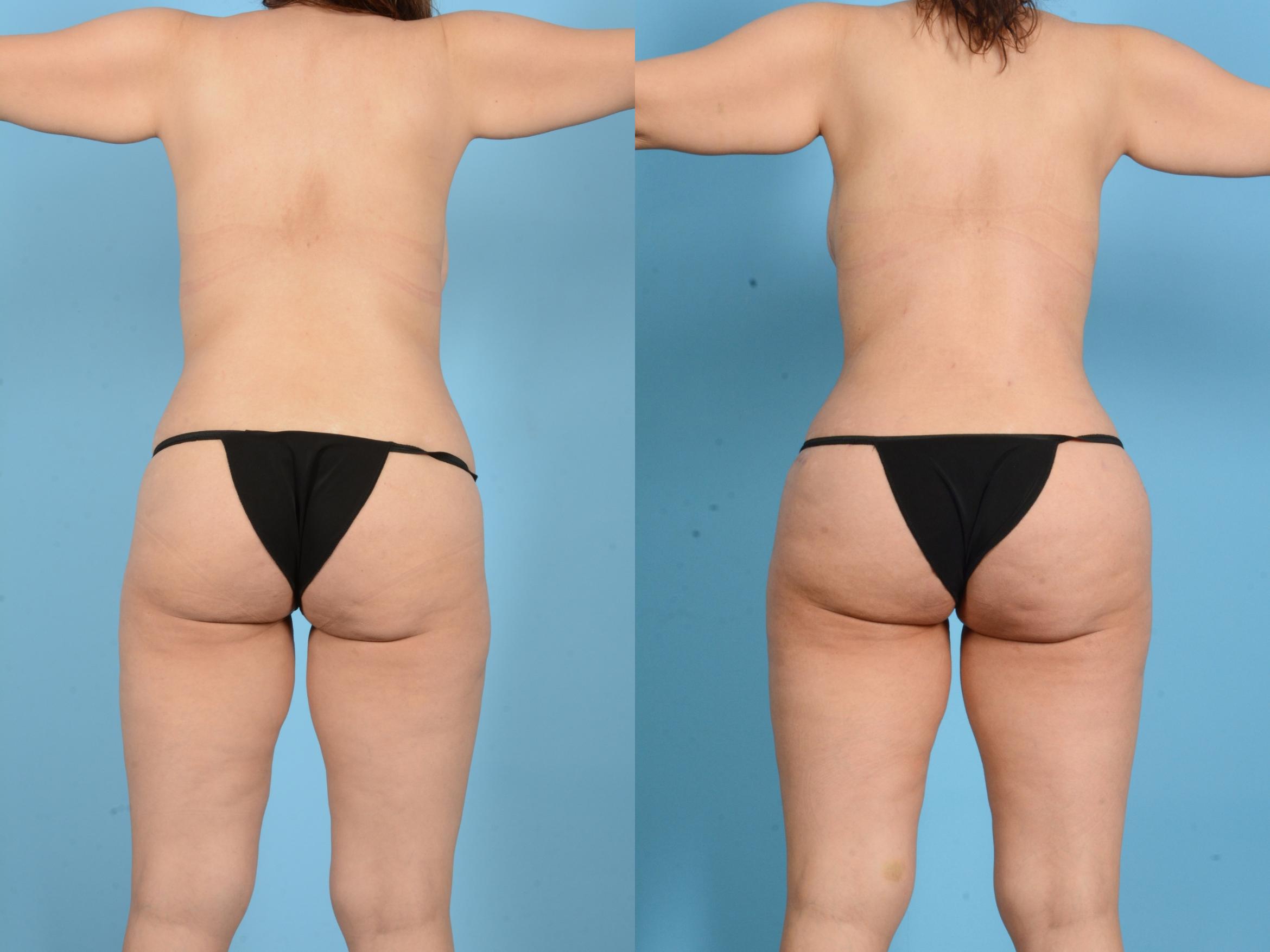Before & After Brazilian Butt Lift Case 18134 Back View in Houston, TX