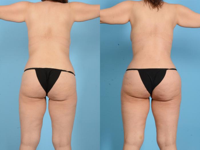 Before & After Brazilian Butt Lift Case 18134 Back View in Houston, TX